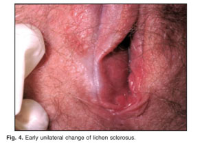 cigarette paper skin appearance lichen sclerosus A folliculocentric variant of extragenital