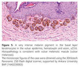 vulvar melanotic macule histology Vulvovaginal melanocytic lesions: a review Pathology Outlines - Melanotic macule
