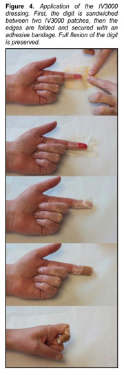 IV 3000 dressing for fingertip injury: management and discussion - Document  - Gale OneFile: Health and Medicine