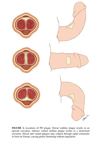 reliable bpc 157 source Peyronie's disease: evolving surgical management and the role of  phosphodiesterase 5 inhibitors. - Document