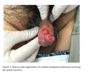 melanotic macules penis Melanosis | PDF | Cutaneous Conditions JLE - European Journal of