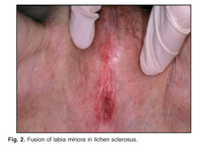 cigarette paper skin appearance lichen sclerosus Vulvar lichen sclerosus: pathophysiology and treatment. - Document