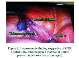 tobacco pouch appearance appearance: HSG sign of tubercular salphingitis | Abdominal Radiology Tobacco pouch : The origin
